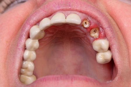 Closeup of broken artificial tooth and inflammation, gingivitisの写真素材