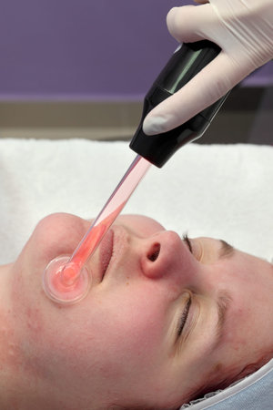 Beauty treatment of face skin with high frequency infrared spot remover  in SPA center