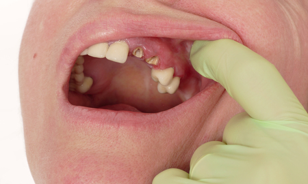 Closeup of broken artificial tooth and inflammation, gingivitisの写真素材