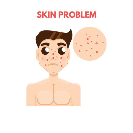 Men skin problem. Facial care. Vector illustration.のイラスト素材