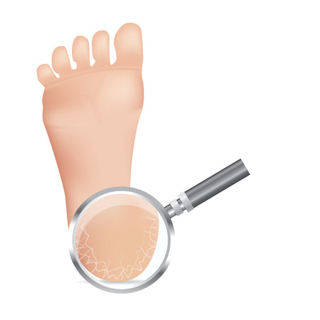 Cracked heels on white background Vector illustration.のイラスト素材