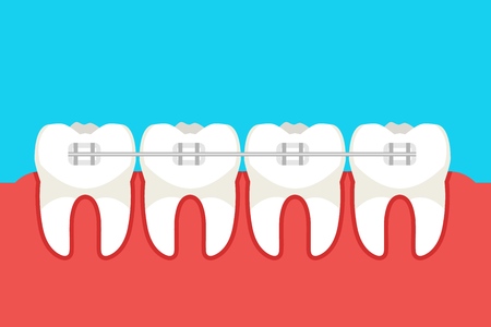 Human teeth with metal braces. Vector illustration.のイラスト素材