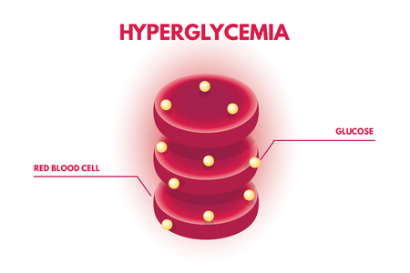Hyperglycemia, Human glucose levels isometric. Vector illustration.のイラスト素材