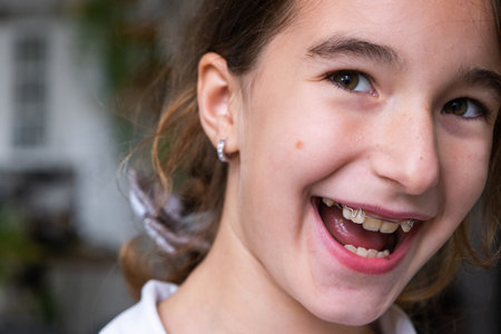 Happy smile with fitted orthodontic plate, child shows successful teeth alignment after pediatric...