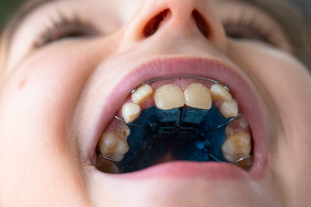 Extreme close-up: upper jaw with blue orthodontic expander, pediatric palate correction device...