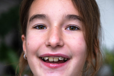 Young girl age 9 showing smile with crooked teeth, removable orthodontic plate for jaw correction.の写真素材