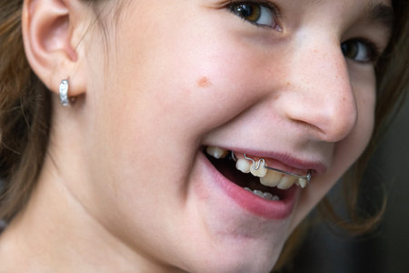 Joyful girl with corrected smile after orthodontic plate, healthy teeth and confident look.