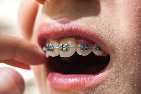Ajar mouth with a dental metal dental appliance for the teethの写真素材