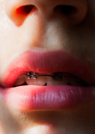 Close-up of ajar mouth with a dental metal dental appliance for the teethの写真素材