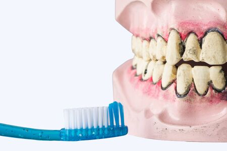 dental prosthesis with bad teeth, infected gums and tooth brush.  dentures showing cavities.  Dental Health for prevention.の写真素材