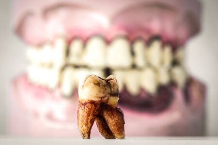 partial wooden dentures and real tooth with caries and cavities. Dental Health care.の写真素材