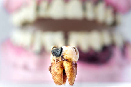 partial wooden dentures and real tooth with caries and cavities. Dental Health care.の写真素材