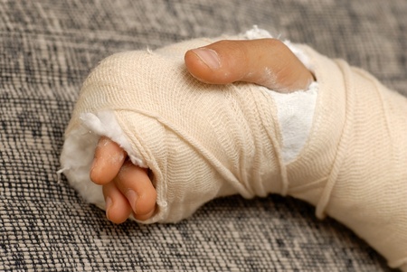 broken arm bone in a cast and bandages over gray backgroundの写真素材