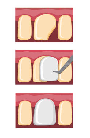 veneer teeth procedure, dental filling on broken tooth cartoon flat illustration vector isolated in white backgroundのイラスト素材