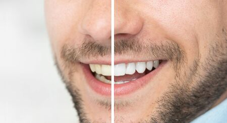 Dental care and whitening teeth. Compare smile before and after bleaching.の写真素材