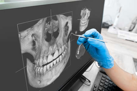 Doctor looking at human teeth x-ray on computer monitor. Modern dental clinic.の写真素材