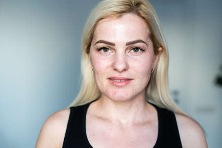 woman papules face, skin texture of woman.の写真素材