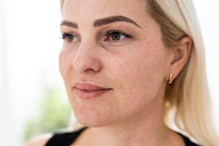 Real skin Biorevitalization on white background. Traces of biorevitalization injections on woman face. Biorevitalization needle marks Beauty treatment, real papules after hyaluronic injection.の写真素材