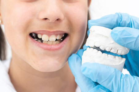 Orthodontists hand, covered in a blue medical glove holding a dental mold of the lower jaw. The...