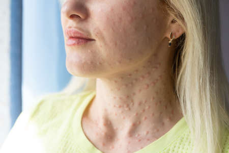 Real skin Biorevitalization on white background. Traces of biorevitalization injections on woman face. Biorevitalization needle marks Beauty treatment real papules after hyaluronic injection Close up.の写真素材