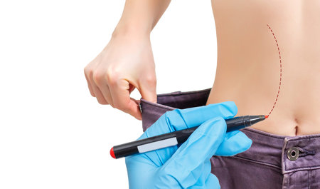 Plastic surgery doctor draw lines with marker on patient belly - isolated on white background