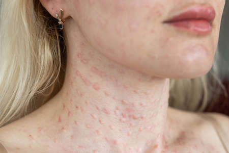 Real skin Biorevitalization on white background. Traces of biorevitalization injections on woman face. Biorevitalization needle marks Beauty treatment real papules after hyaluronic injection Close up.の写真素材