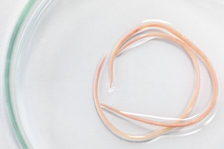 Ascariasis is a disease caused by the parasitic roundworm Ascaris lumbricoides for education in...