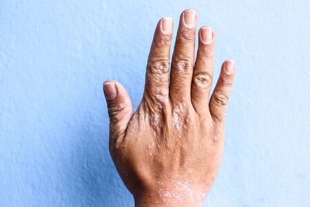 A physical of Atopic dermatitis (AD), also known as atopic eczema, is a type of inflammation of the...
