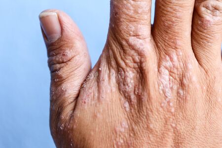 A physical of Atopic dermatitis (AD), also known as atopic eczema, is a type of inflammation of the...