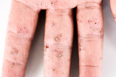 A physical of Atopic dermatitis (AD), also known as atopic eczema, is a type of inflammation of the skin (dermatitis).の写真素材