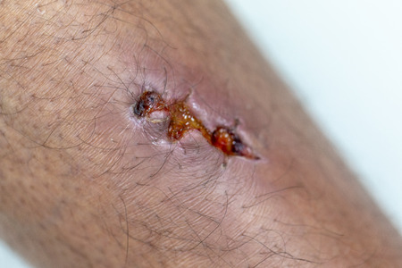 Closeup injured at leg, Fresh wounds from accident.の写真素材