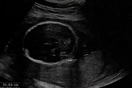 Ultrasound of baby in mother's at hospital.