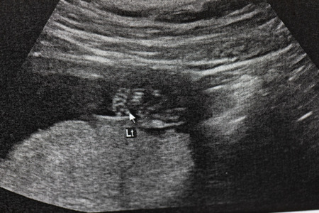 Ultrasound of baby in mother's at hospital.