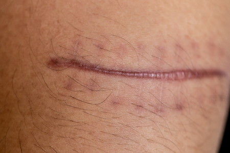 A scar is an area of fibrous tissue that replaces normal skin after an injury on skin.