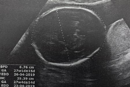 Ultrasound of baby in pregnant woman, Doctor reading test results of pregnant woman by ultrasound.の写真素材