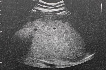 Ultrasound of baby in pregnant woman, Doctor reading test results of pregnant woman by ultrasound.