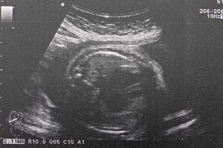 Ultrasound of baby in pregnant woman, Doctor reading test results of pregnant woman by ultrasound.