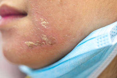 Backgrounds of lesions skin caused by acne on the face in the clinic.