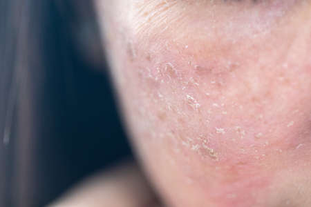 Backgrounds of lesions skin caused by acne on the face in the clinic.