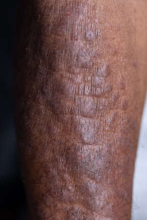 A physical of Atopic dermatitis (AD), also known as atopic eczema, is a type of inflammation of the skin (dermatitis).の写真素材