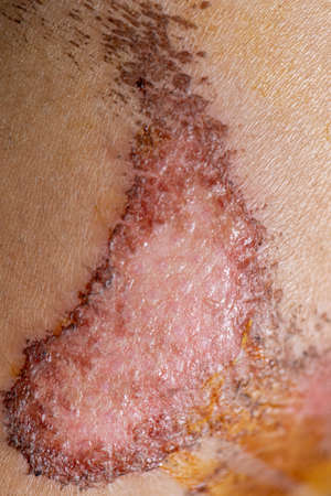 Closeup injured, Fresh wounds from accident.