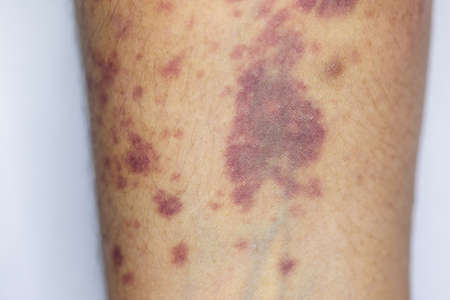 The physical appearance of the arm with the wound is caused by Haemophilia, (Haemophiliais a mostly...
