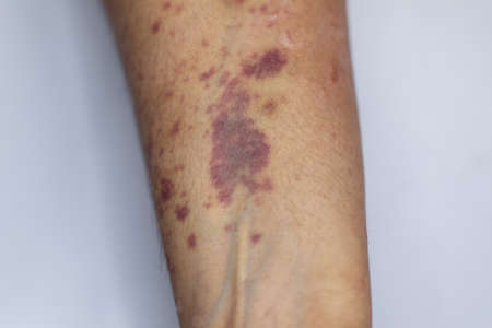 The physical appearance of the arm with the wound is caused by Haemophilia, (Haemophiliais a mostly inherited genetic disorder)の素材 [FY310164121788]