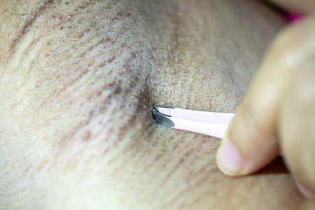 Scalp and hair follicles of human under the microscope in Lab.