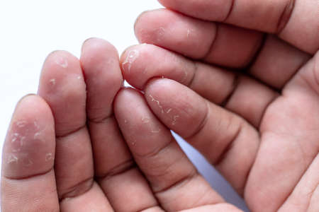 Pattern of Atopic eczema and fungal diseases on the human body.