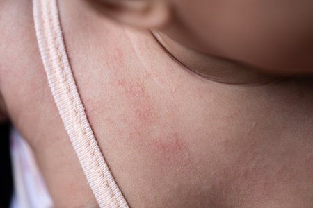 Pattern of Atopic eczema and fungal diseases on the human body.
