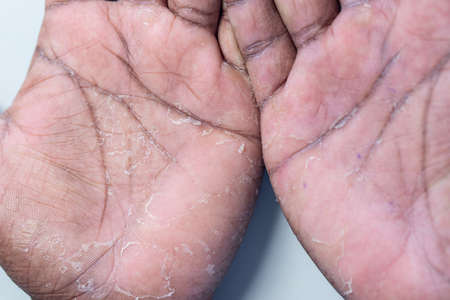 Pattern of Atopic eczema and fungal diseases on the human body.の写真素材