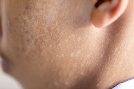 Pattern of Atopic eczema and fungal diseases on the human body.の写真素材