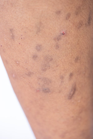 Pattern of Atopic dermatitis and fungal diseases on the human body.の写真素材