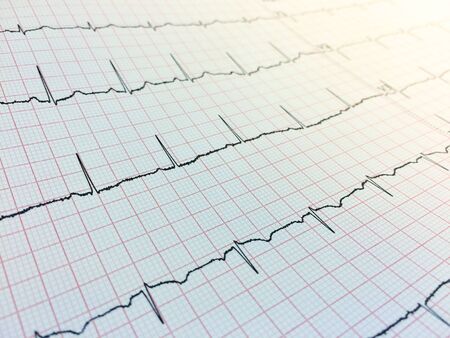 Close up of Electrocardiogram, Electrocardiography or EKG chart. Rhythm of heart on graph using for...